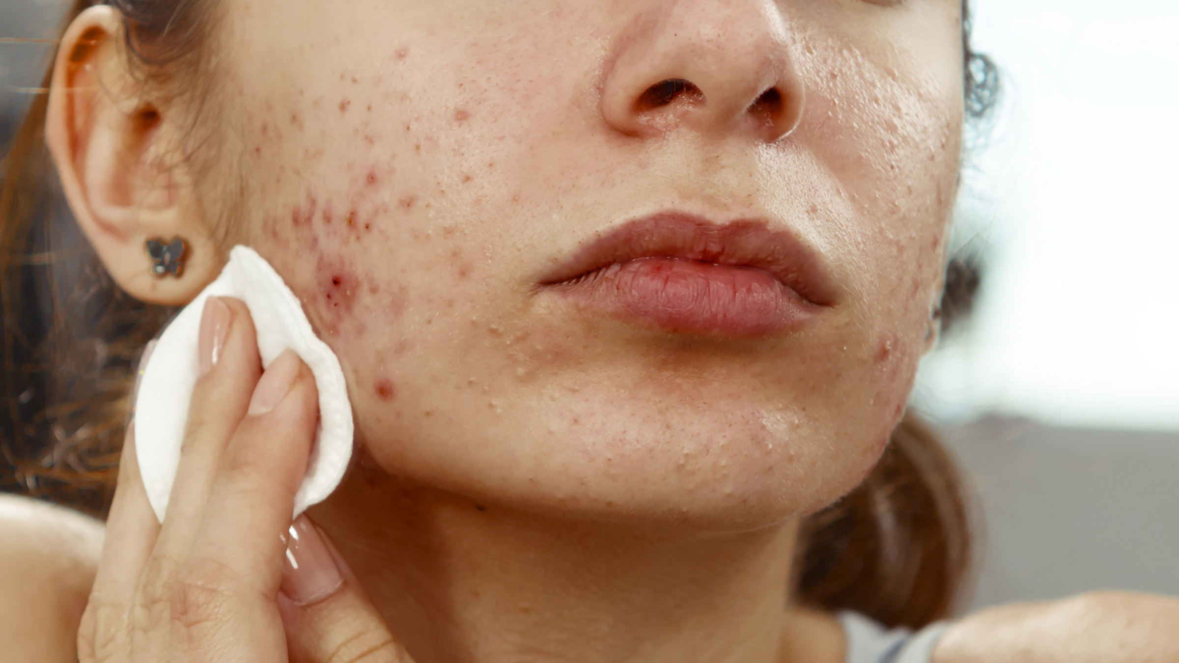 How to Treat Old Scars with Acne Scar Treatment?