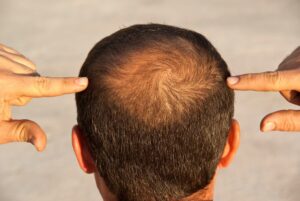 Non Surgical Hair Replacement in Dubai