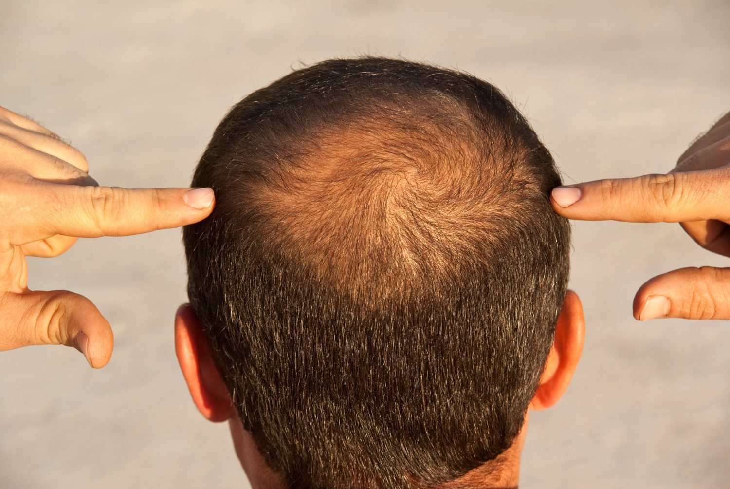 Non Surgical Hair Replacement in Dubai